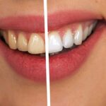 How to have white teeth with braces?